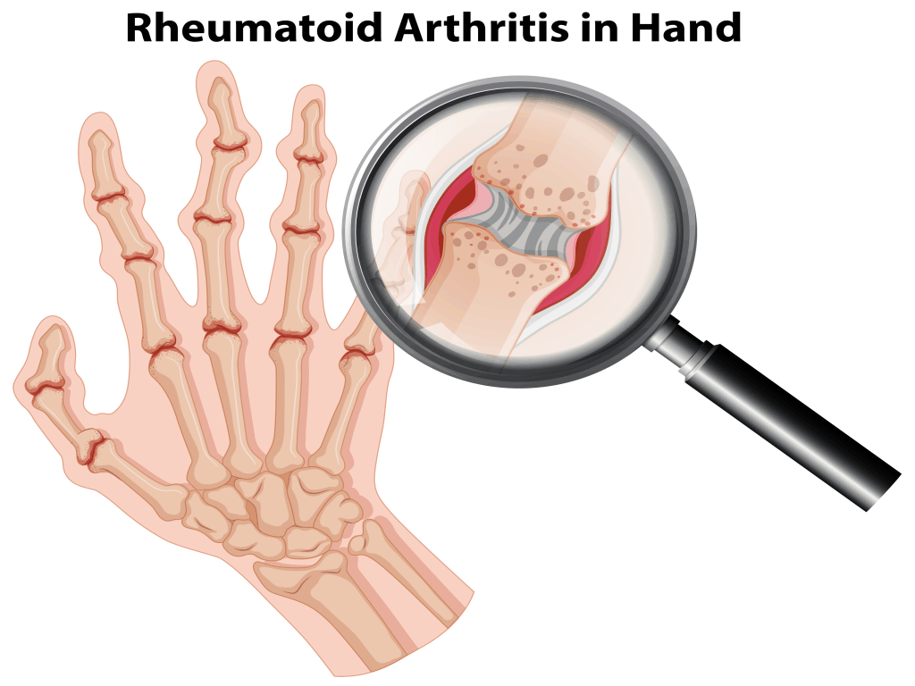 Rheumatoid Arthritis Treatment Can Arthritis Be Cured