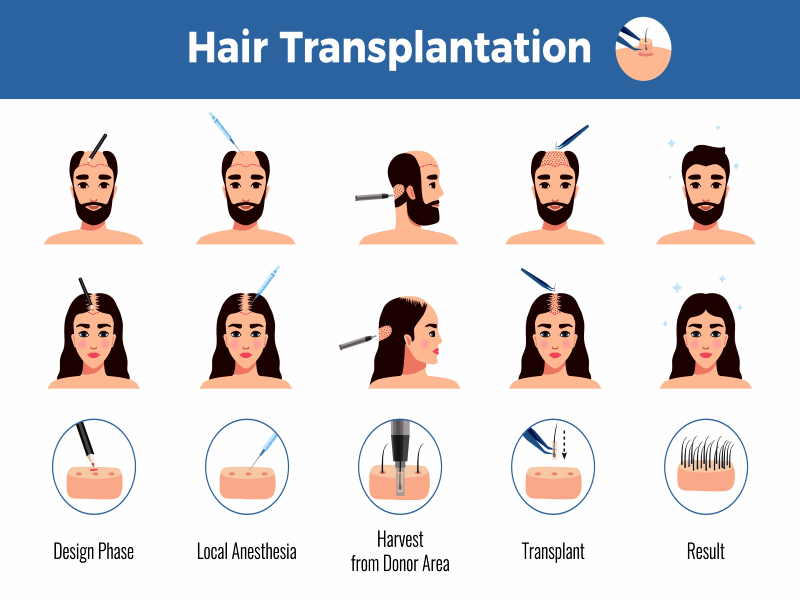 What Is The Best Age For Hair Transplant In Dubai 1
