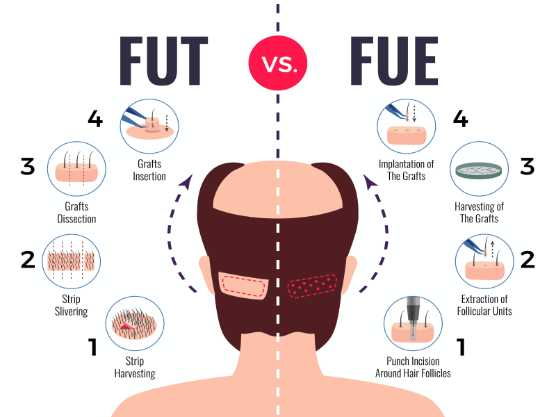 What Is The Best Age For Hair Transplant In Dubai 2