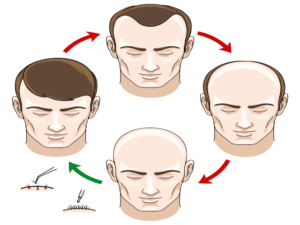 Read more about the article What is the best age for hair transplant in Dubai?