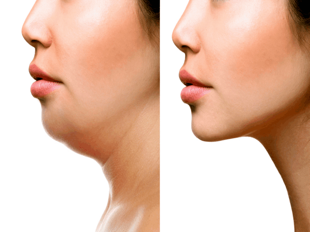 Why People Love Kybella Double Chin Treatment Procedure All Over The World 1