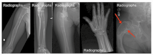 Metabolic Bone Disease - Symptoms, Causes, Diagnosis, Treatment And Prevention In Human Fibrous Dysplasia