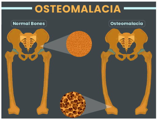 Metabolic Bone Disease - Symptoms, Causes, Diagnosis, Treatment And Prevention In Human Osteomalacia