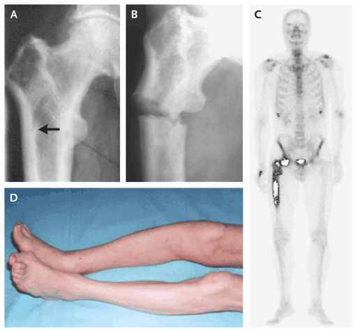 Metabolic Bone Disease - Symptoms, Causes, Diagnosis, Treatment And Prevention In Human Pagets disease